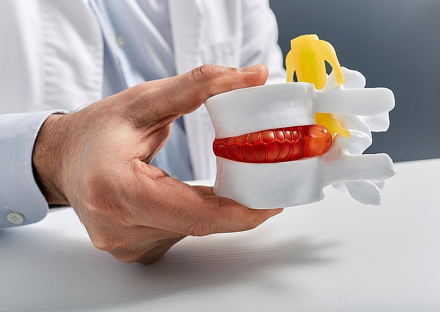 Spinal Surgery for Herniated Disc: When Is It Necessary?